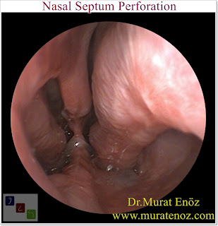 Nasal Septal Perforation - Nasal Septum Perforation