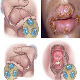 Obat kencing nanah sesuai resep dokter, obat gonore (kencing nanah) untuk wanita hamil, obat antibiotik untuk sipilis, obat gonore (kencing nanah) yang dapat di beli di apotik, obat kencing nanah hpai, obat sipilis kaskus, obat sipilis buat wanita, obat tradisional untuk gonore, obat sipilis apotik, konsultasi sipilis, obat penyakit gonore (kemaluan keluar nanah) yang ada di apotik