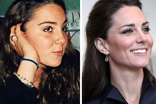 kate middleton Nose Job?