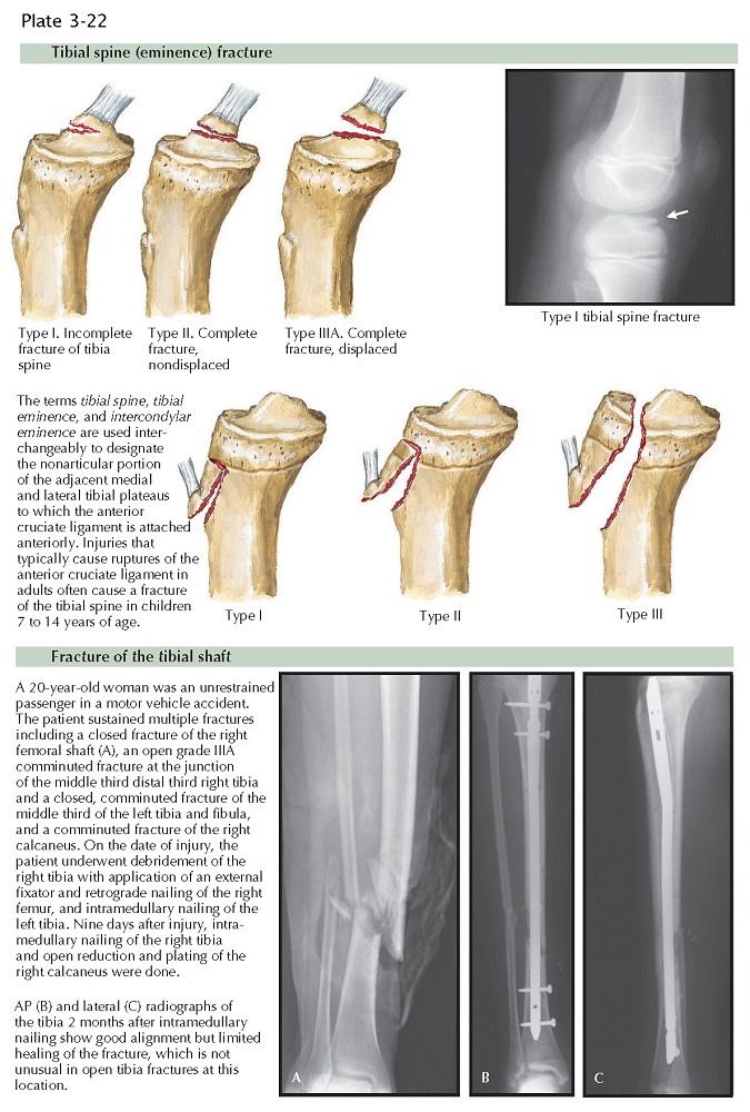 TIBIAL INTERCONDYLAR EMINENCE FRACTURE pediagenosis