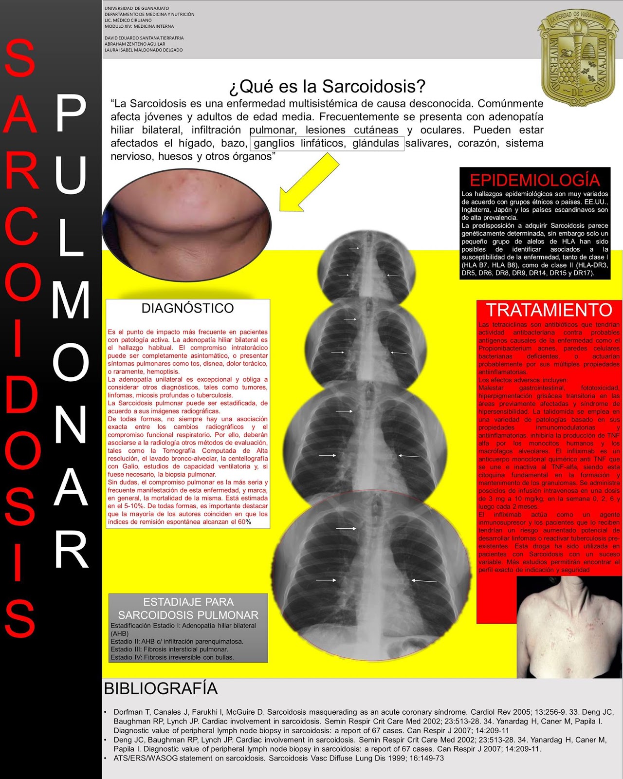 DIVULGACIÓN CIENTÍFICA UG Sarcoidosis Pulmonar