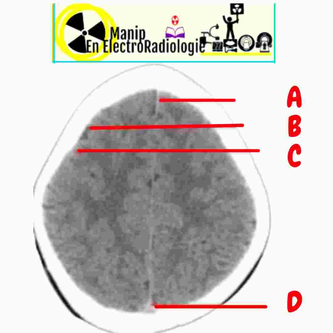 Structures anatomiques du tdm cérébral normal au niveau supérieur