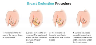Breast Reduction Procedure
