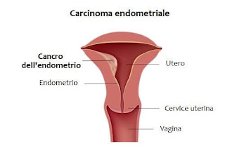 Tumore dell'endometrio