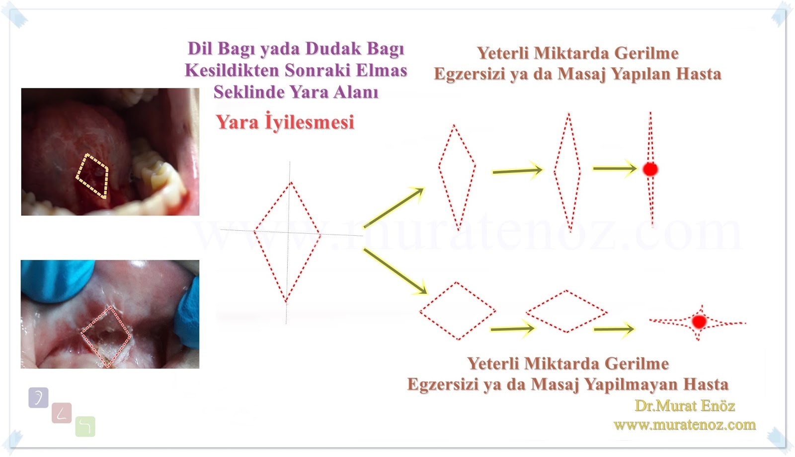 Bebeklerde Dil Bağı Masajı ve Dudak Bağı Masajı İçin İki Bebeklerde Dil Bağı Masajı ve Dudak Bağı Masajı İçin İki