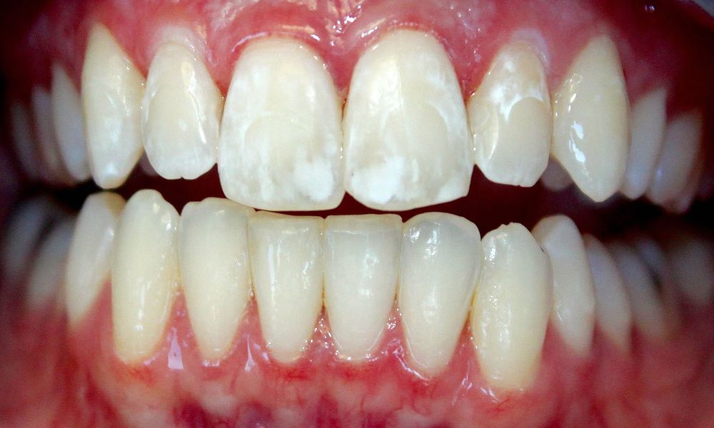 How To Get White Spots Off Teeth With Braces Reverasite