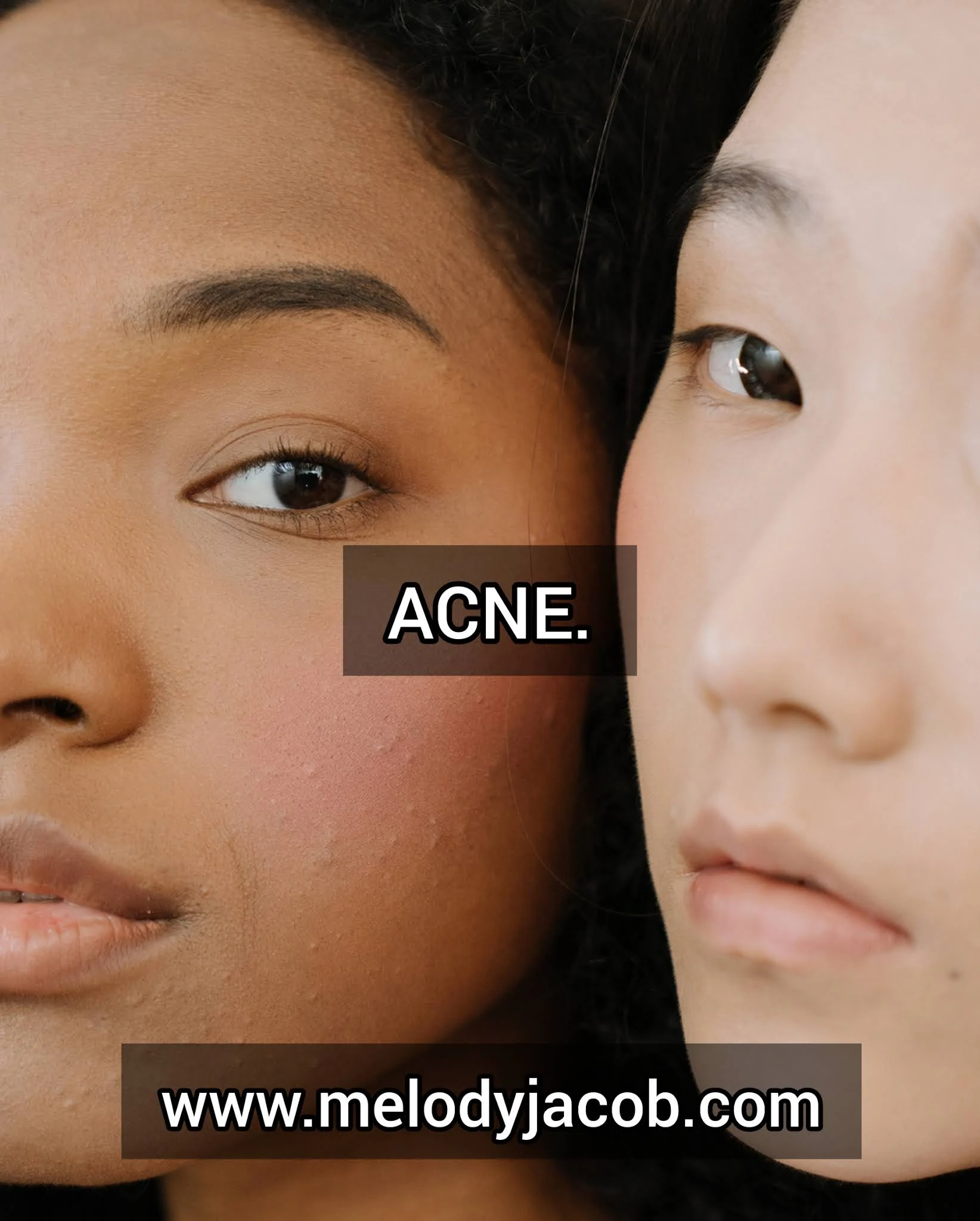 Acne: Causes, Symptoms, Diagnosis and Treatment