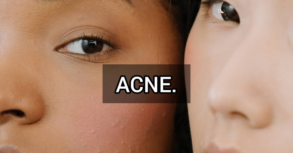 Acne: Causes, Symptoms, Diagnosis and Treatment