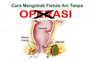 Image OBAT DE NATURE UNTUK MENYEMBUHKAN FISTULA ANI TANPA OPERASI