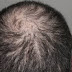 How to prevent hair fall and cause of hair fall
