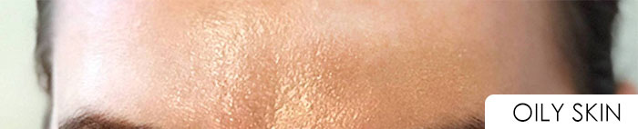 oily skin