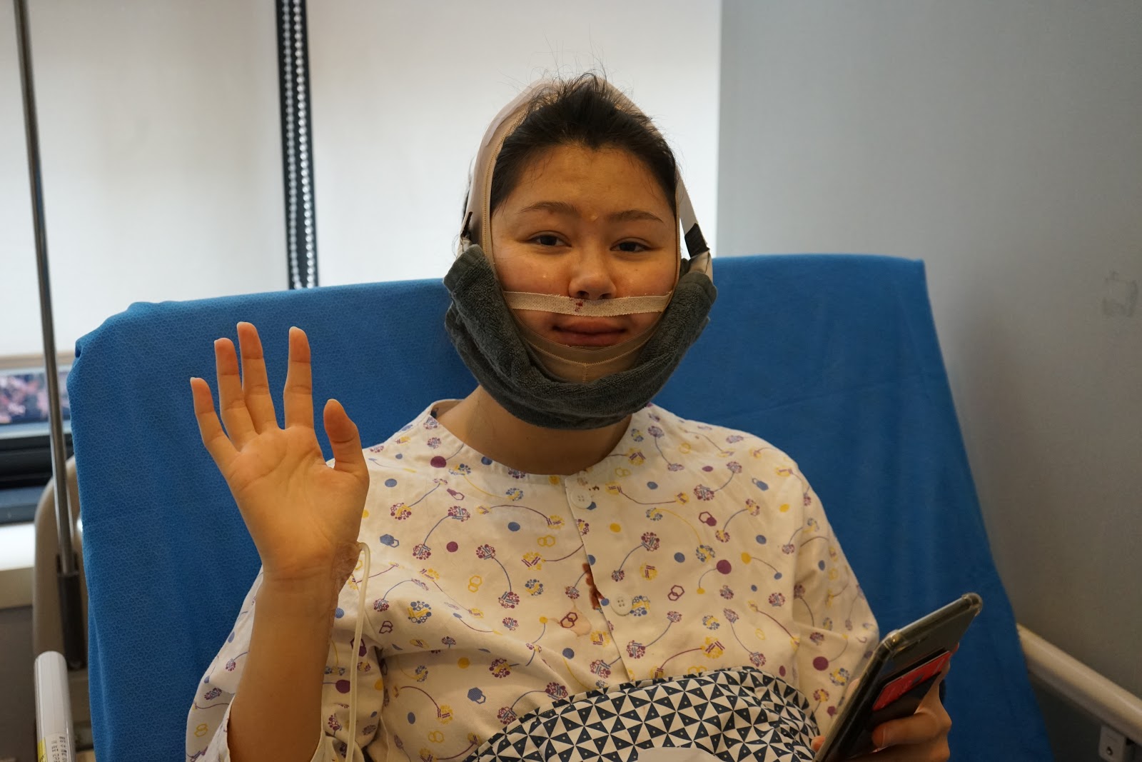 Double Jaw & Vline Surgery Post OP 1 Week (Patient from England)