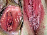 Bintik-bintik Merah Di Bibir Vagina Seperti Daging Tumbuh