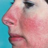 "Mild" Rosacea