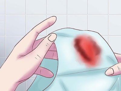 xuất huyết âm đạo là dấu hiệu tụ dịch màng nuôi xuất huyết âm đạo là dấu hiệu tụ dịch màng nuôi