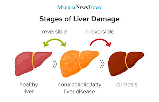 https://i0.wp.com/post.medicalnewstoday.com/wp-content/uploads/sites/3/2020/02/Stage-of-Liver-Disease_ver5-1024x655.jpg?w=1155&h=2150