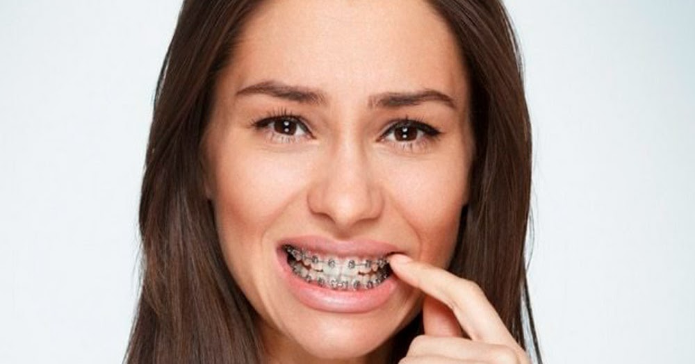 BULAN PERTAMA BRACES ! HOW THE PAIN?