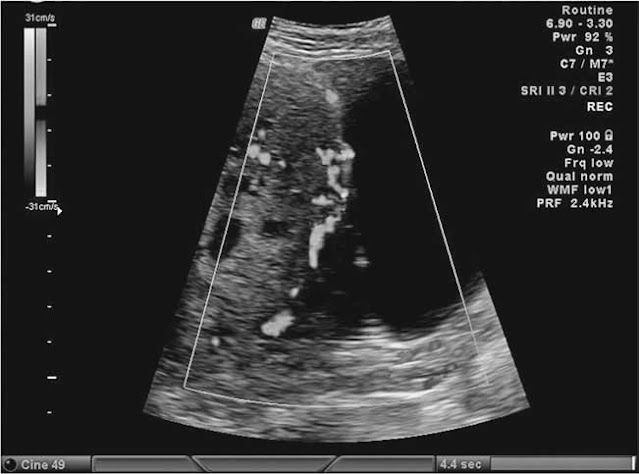 Ultrasound of a placenta accreta