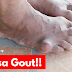 Penyakit Gout- Punca, Tanda-Tanda Dan Set Gout Shaklee