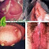 Obat Kencing Nanah Gonore