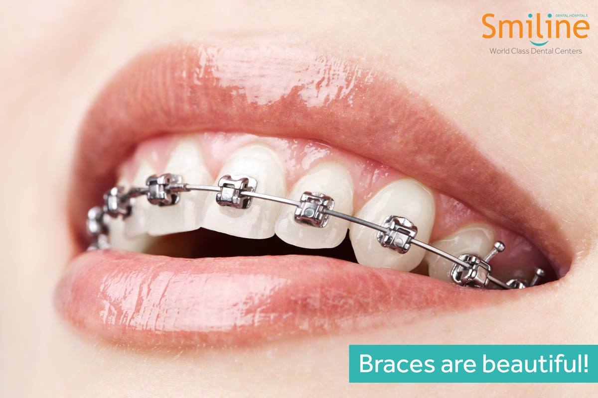 Best Teeth Braces in Hyderabad