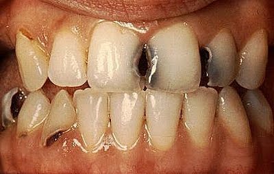 Hasil gambar untuk Karies gigi