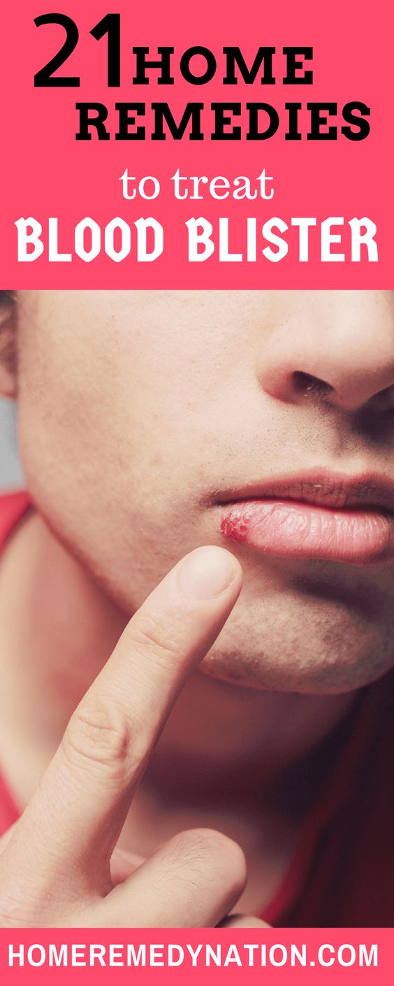 Preventive Diabetes how to get rid of diabetic blisters