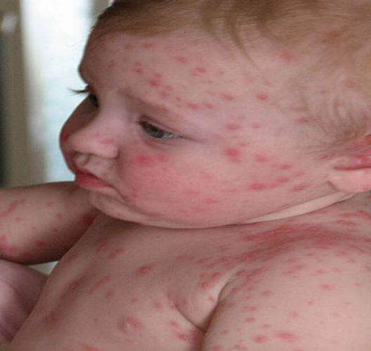 Chicken Pox Signs and Symptoms