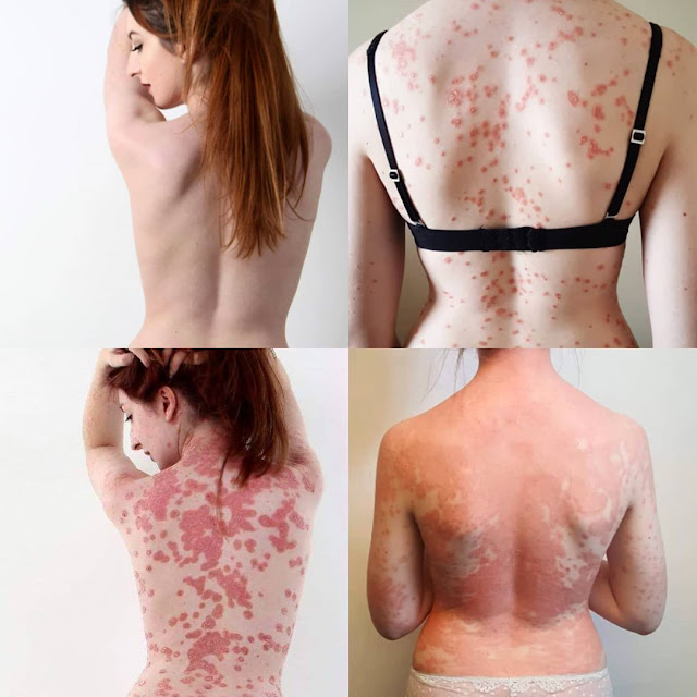 Dermatite atopique: combattez-la avec ce traitement révolutionnaire
