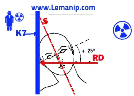 Incidence De MAXILLAIRE DEFILE