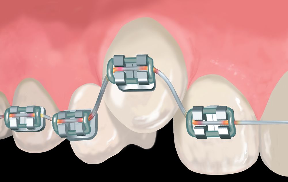 Is extraction of teeth necessary before going for Orthodontic Treatment