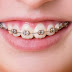 Niềng răng mắc cài kim loại có ưu điểm gì? 