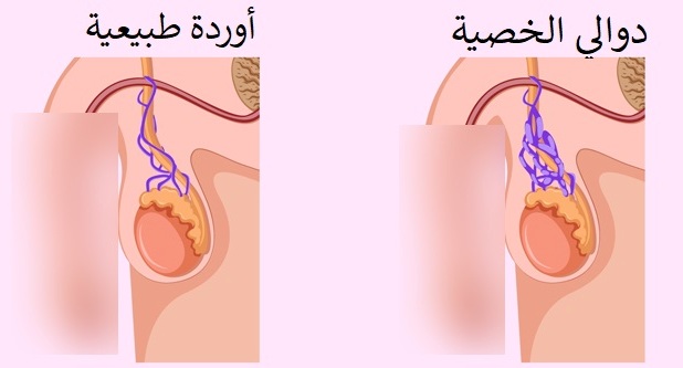 دوالي الخصية