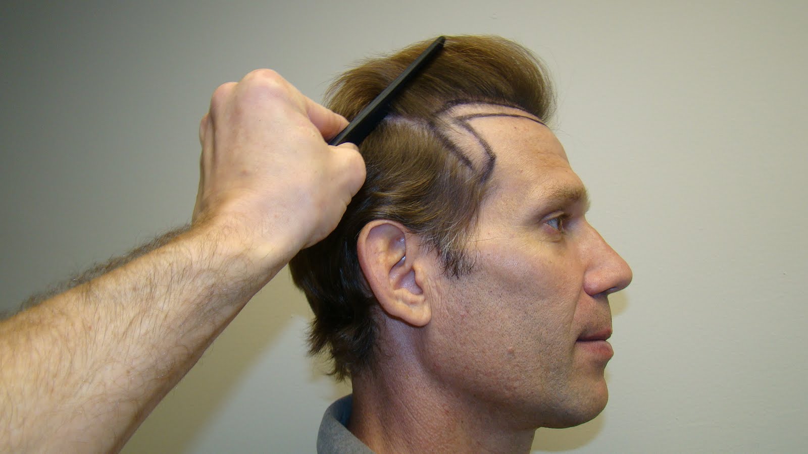 Hair Transplant Hairline at 7 Months Dr. Brett Bolton Blog