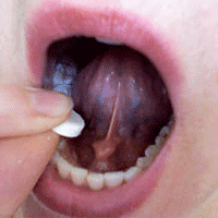 Dosis pemakaian cytotec misoprostol dosis cytotec misoprostol