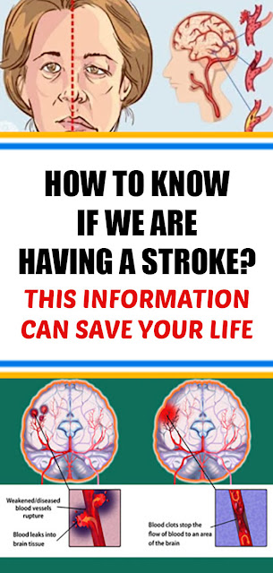How To Know If We Are Having A Stroke? This Information Can Save Your Life!