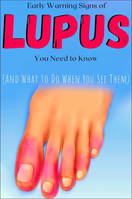13 Early Warning Signs of Lupus You Need to Know (and what to do the