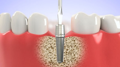 Chăm sóc răng sau cấy implant như thế nào?-2