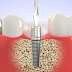 Cách chăm răng sóc sau cấy implant như thế nào?
