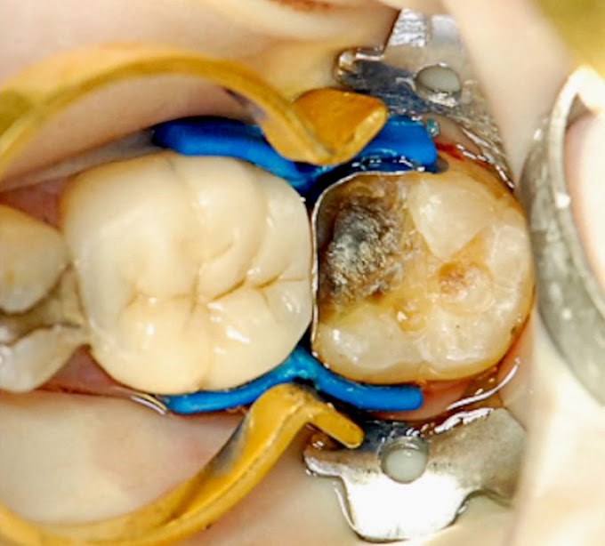 OPERATIVE DENTISTRY: Restoring that broken molar and the difficult class II cavity