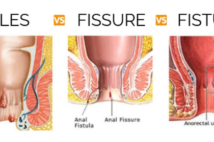 Best doctors in ujjain | Piles Fistula fissure dr treatment