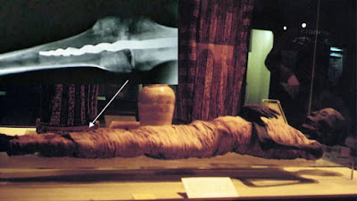 El tornillo encontrado en la rótula de una momia egipcia de 2.600 años