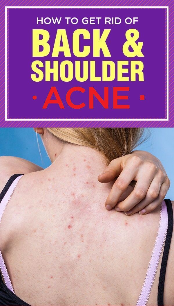 3 Best Remedies For Back Acne - wellness magazine