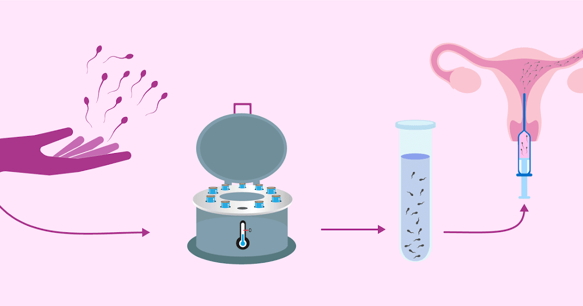 What & How of IUI-Intra-Uterine Insemination.