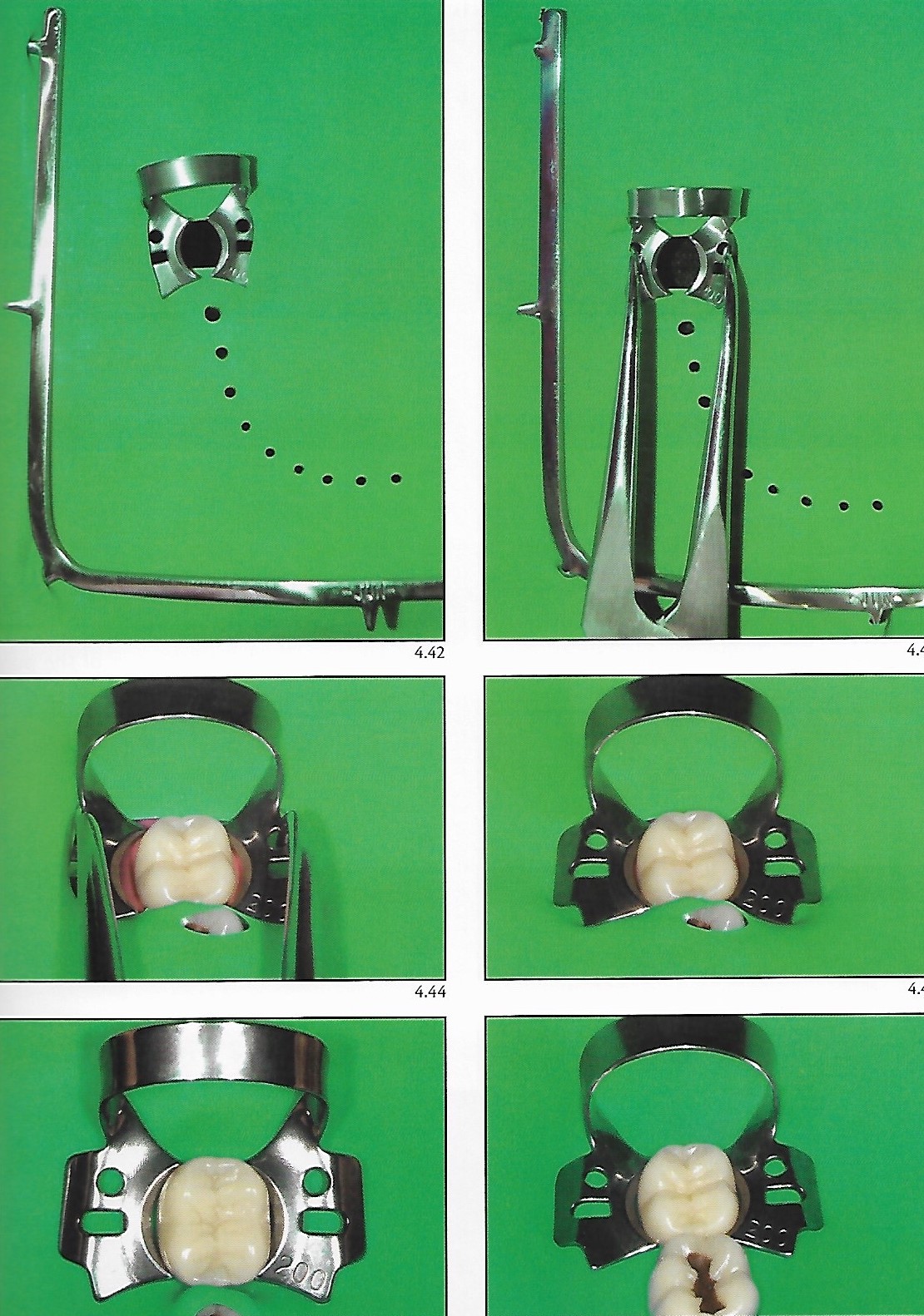 Rubber dam isolation in the posterior segment Dental Esthetics