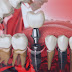 Có nên cấy ghép implant phục hình răng đã mất?