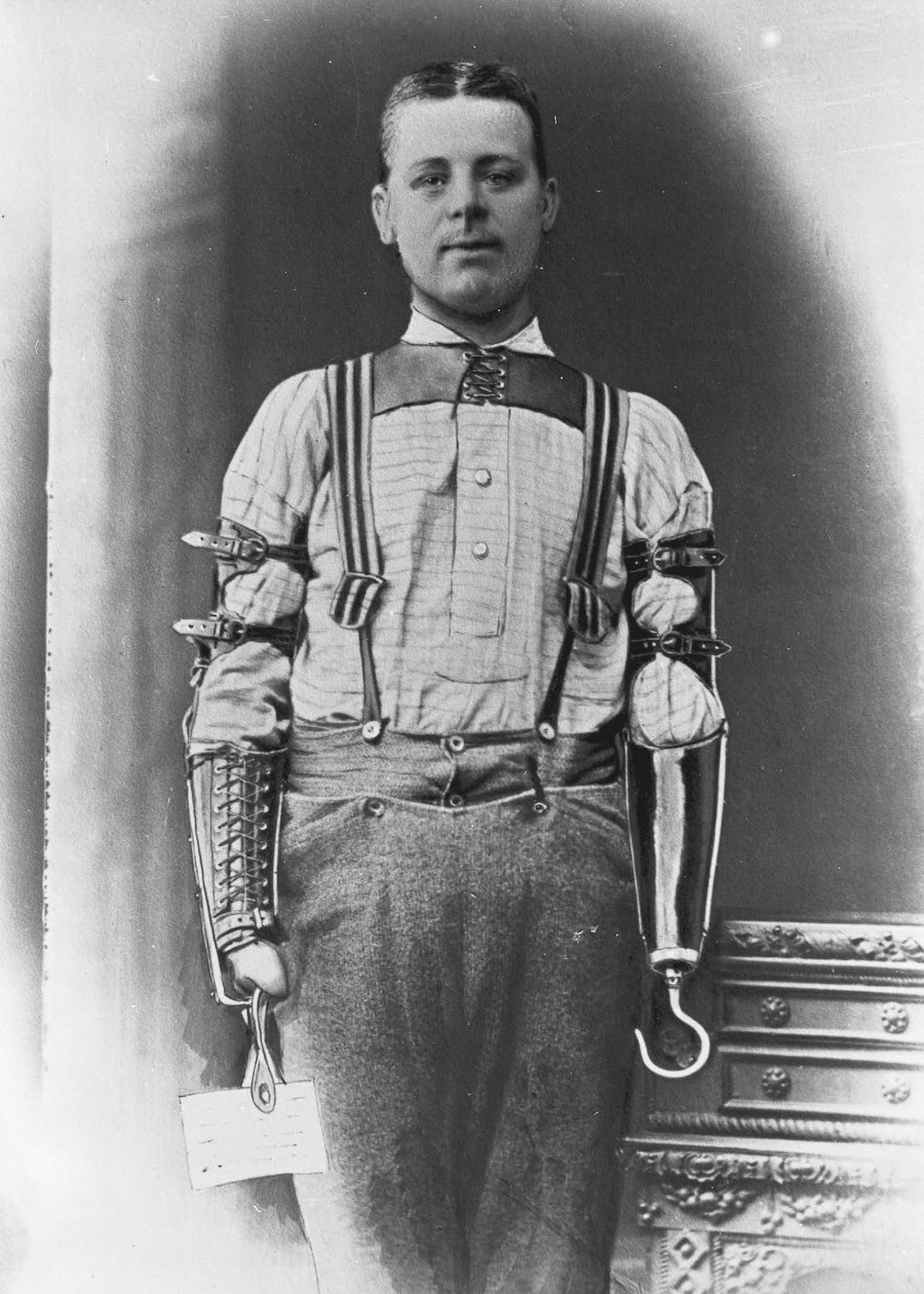 The extraordinary early prostheses made by James Gillingham  1900 - 94