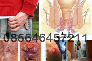 Artikel Penyakit Hemoroid dan Ambejoss Zaitop Artikel Penyakit Hemoroid dan Ambejoss Zaitop