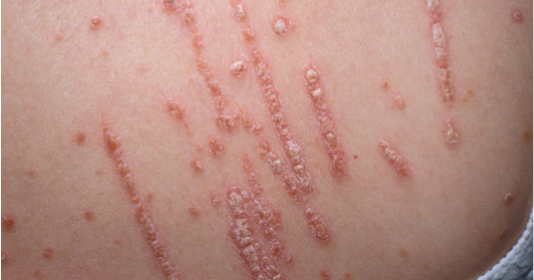 Health On Psoriasisdisorder What is the Koebner