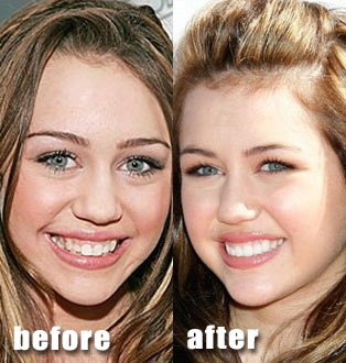 Celebrity Plastic Surgery Before After